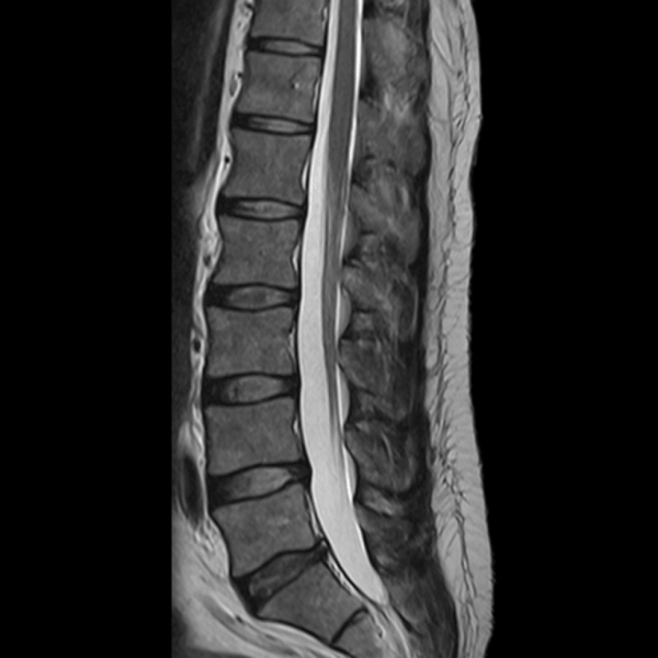 osteocondroza larg răspândită a coloanei vertebrale osteoartrita articulațiilor interfalangiene